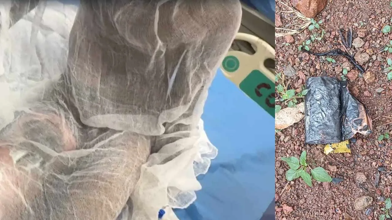 Power Bank Explodes, Fourth-Grade Student Seriously Injured in Sangareddy